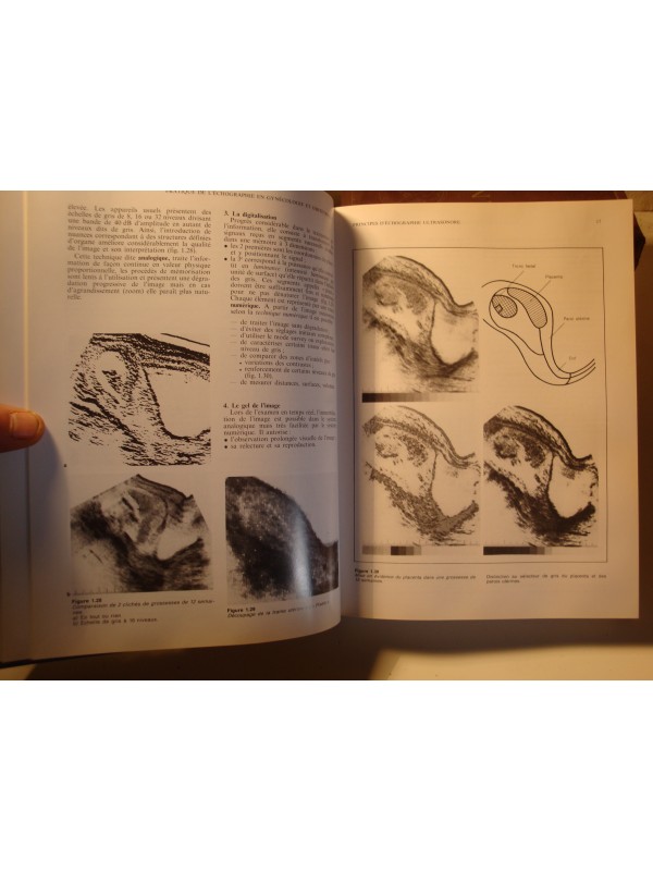 BOUTON/DENHEZ/ÉBOUÉ pratique de l'échographie en gynécologie et obstétrique 1990 Vigot EX++